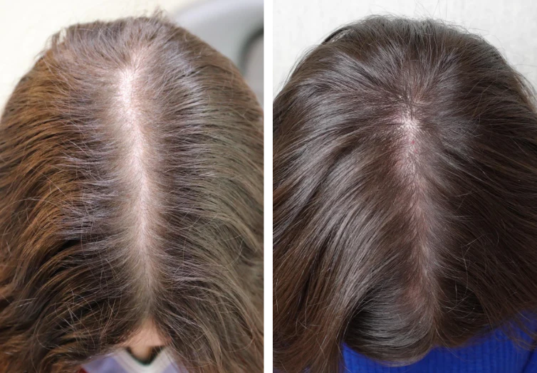 Kirkland Minoxidil 5% Homme Traitement Repousse Cheveux 6 Mois - صورة 2